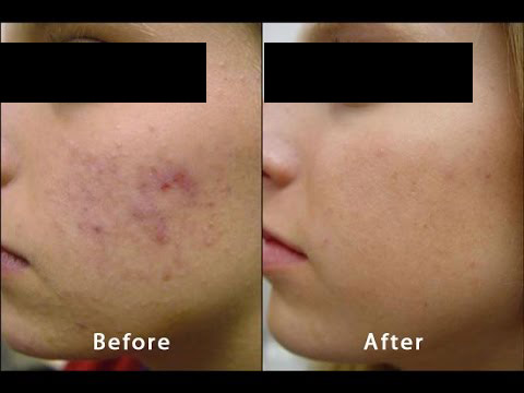 Before having hydro microdermabrasion done Before having hydro microdermabrasion done