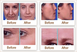 microdermabrasion treatment microdermabrasion treatment