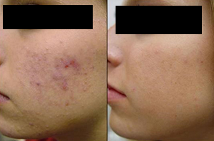 glycolic acid peeling