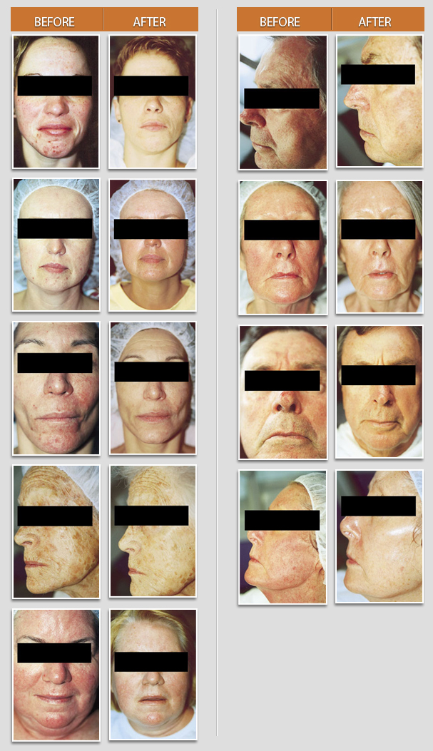 MegaPeel Crystal Microdermabrasion treatment