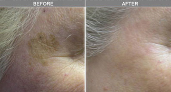 Skin Rejuvenation