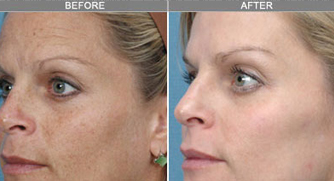 Skin Rejuvenation treatment