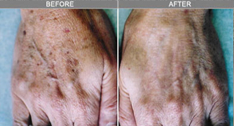 Skin Rejuvenation Skin Rejuvenation