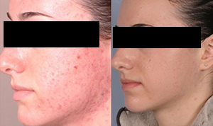 salicylic peel